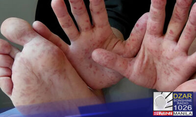 Albay, nakapagtala ng mahigit 500 suspected cases ng hand, foot and mouth disease